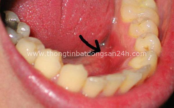 Bác sĩ khuyến cáo: Thói quen khiến đàn ông Việt dễ mắc ung thư vùng miệng 1