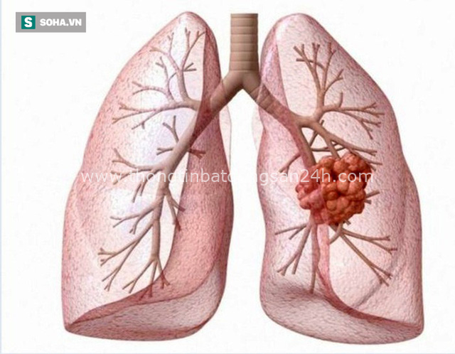  Không hút thuốc vẫn có thể mắc ung thư phổi: Chuyên gia chỉ cách tốt nhất phát hiện bệnh sớm - Ảnh 2.